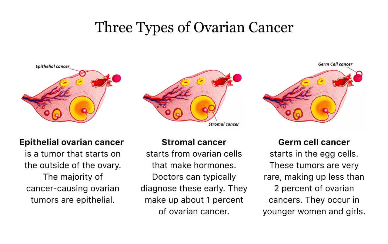 Ovarian Cancer Health Guide Symptoms Types Treatment