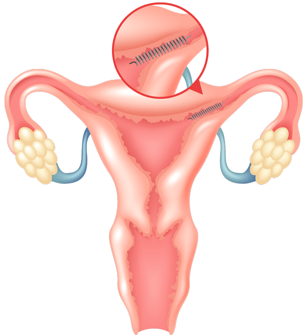 What Is Tubal Ligation foto What Is Tubal Ligation photo