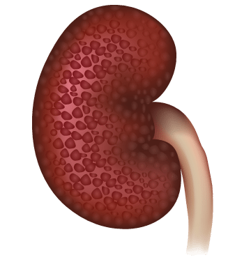 Kidney Disease Riddled Kidney