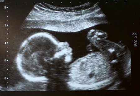 Sonogram Image of Baby in Womb