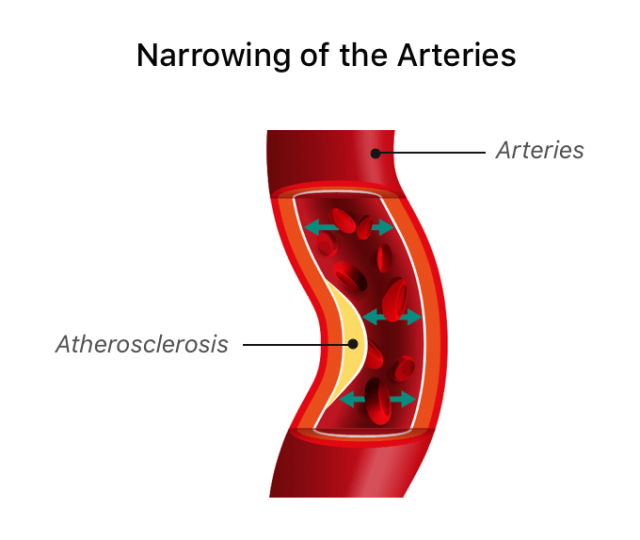Infographic of atherosclerosis