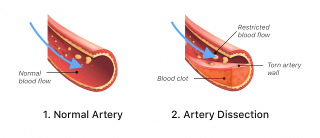 Infographic about artery dissection