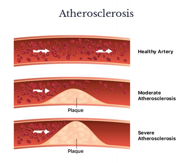 Diagram that shows the different stages of atherosclerosis