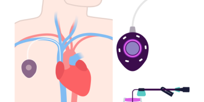 Bard PowerPort Implantable Port