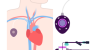 Bard PowerPort Implantable Port