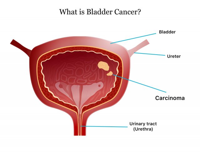 Bladder cancer diagram
