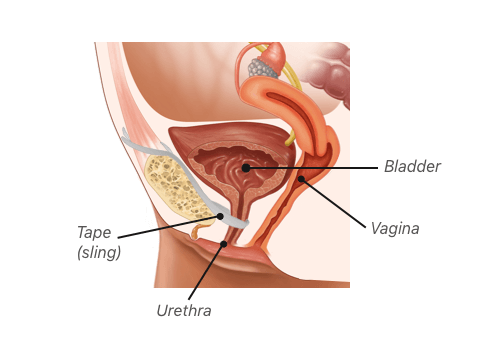 Diagram of bladder sling placement