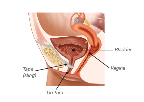 Bladder Sling Complications  Pain, Mesh Erosion & Perforation