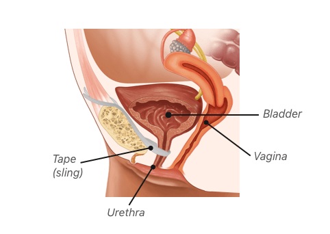 Bladder Sling Complications Pain Mesh Erosion Perforation