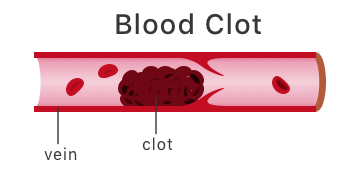 Illustration of blood clot.