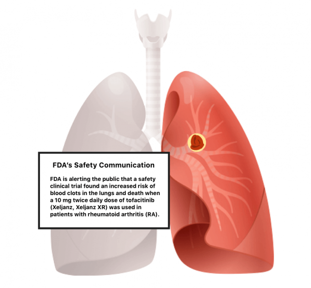 Illustration of a blood blot in the lung