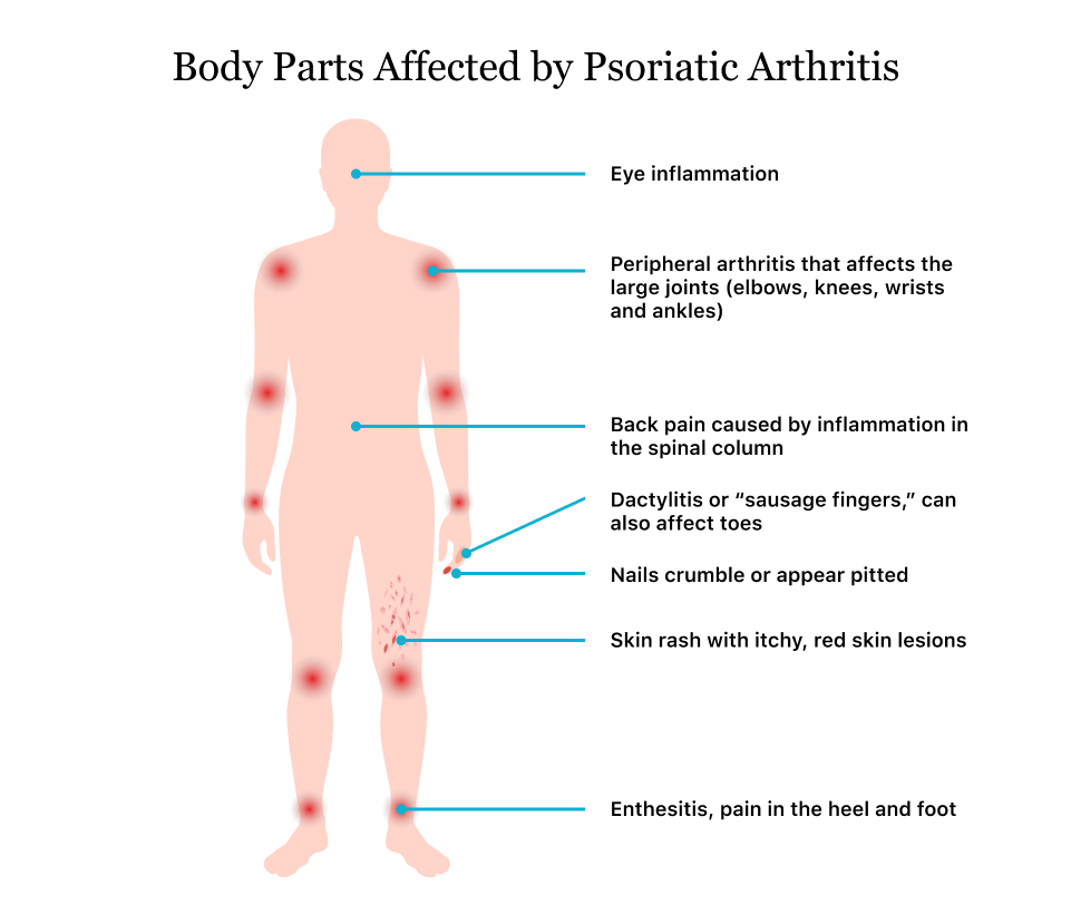 Psoriasisartrit mutilans