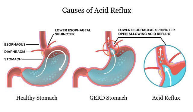 Causes of Acid Reflux