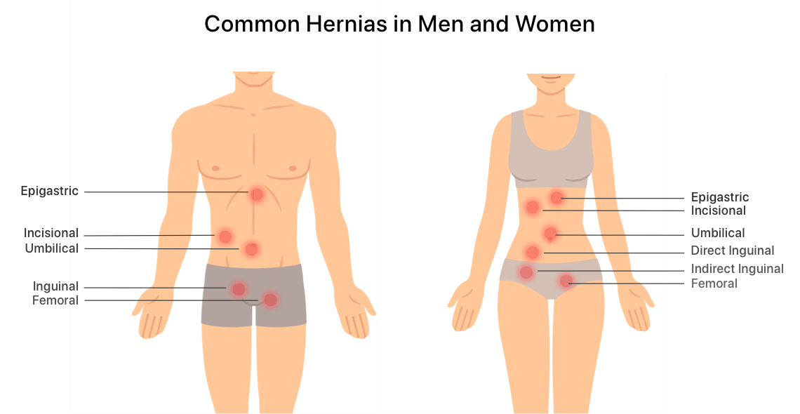 Pulled Groin vs Hernia, What Can be Mistaken for a Hernia?