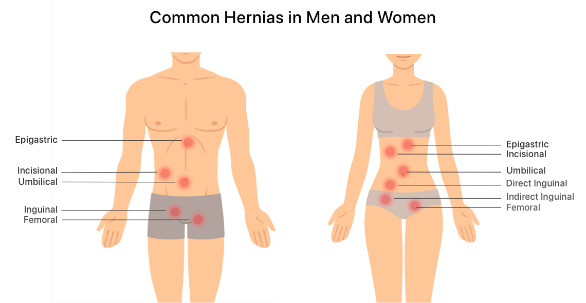 Common hernia locations in men and women