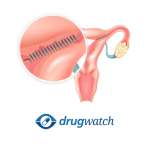 Essure