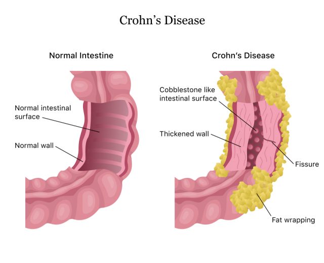 Diagram showing the difference between a normal intestine and an intestine with Crohn's Disease