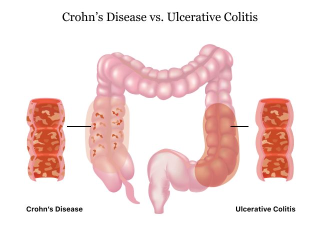 Crohn’s Disease vs. Ulcerative Colitis
