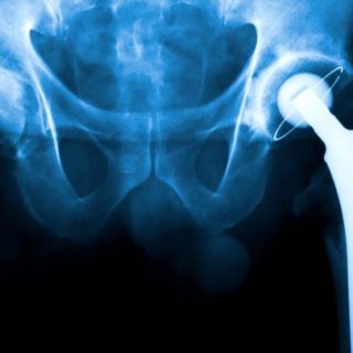 hip replacement surgery xray