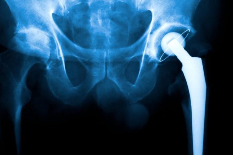 hip replacement surgery xray