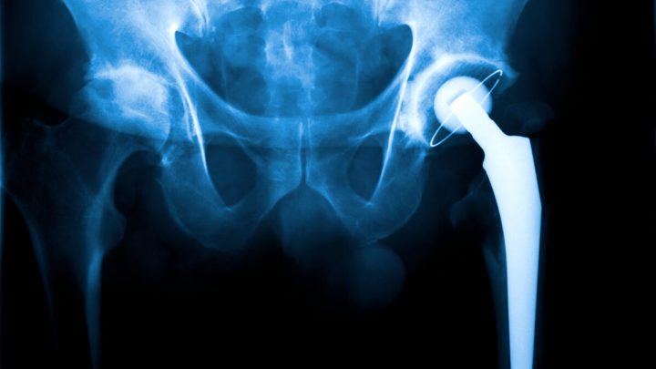 hip replacement surgery xray