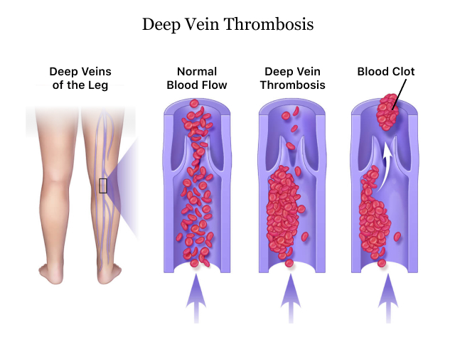 Compression stockings ineffective in treating Deep Vein Thrombosis