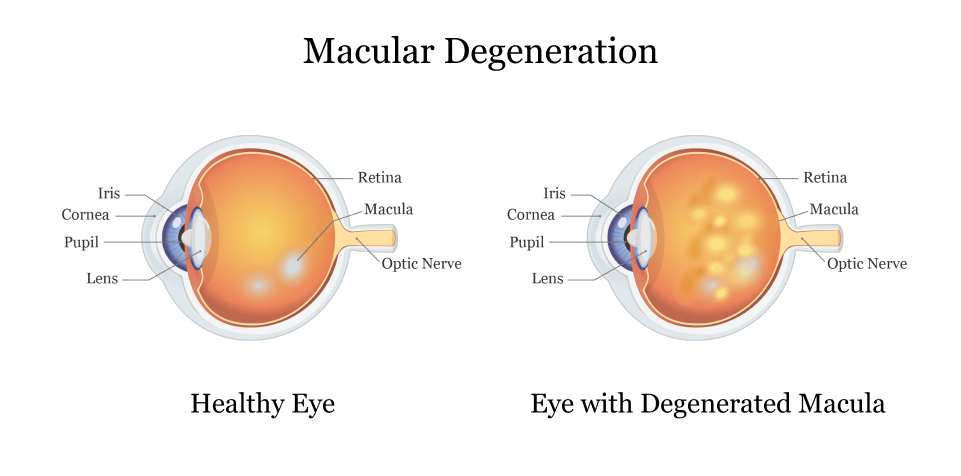 Macular Degeneration And Elmiron