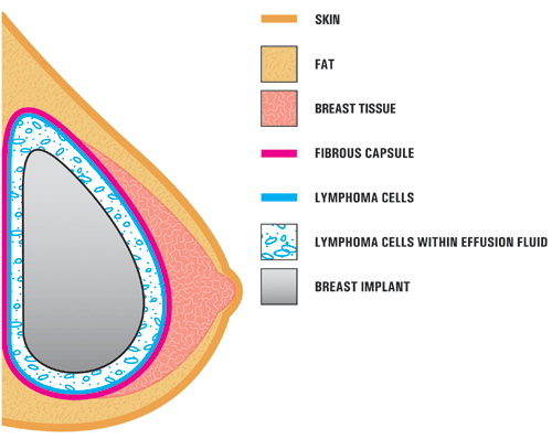 Diagram of breast implant