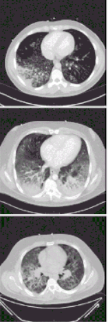 EVALI Lungs CT Scan