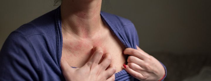 Woman with eczema on her chest