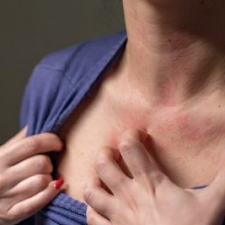 Woman with contact dermatitis on her chest