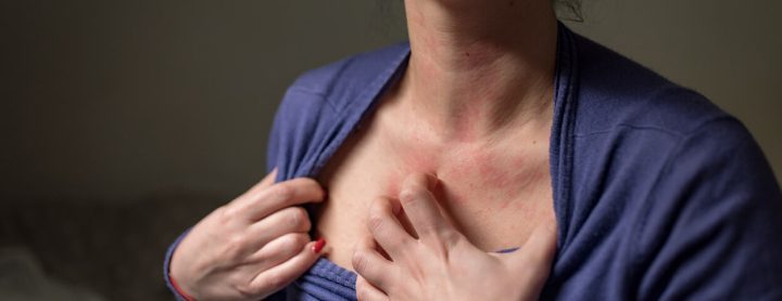 Woman with contact dermatitis on her chest