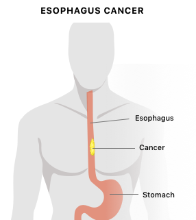 Diagram of esophageal cancer in a human.