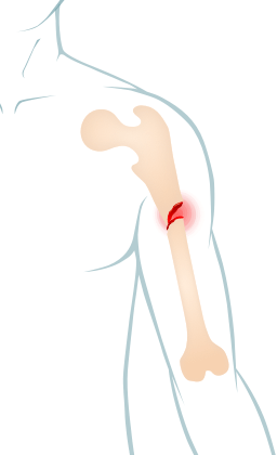 Illustration of fracture bone in arm.