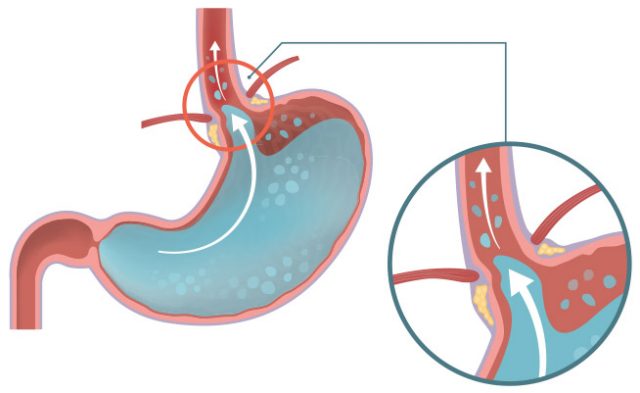 image of stomach acid entering the esophagus