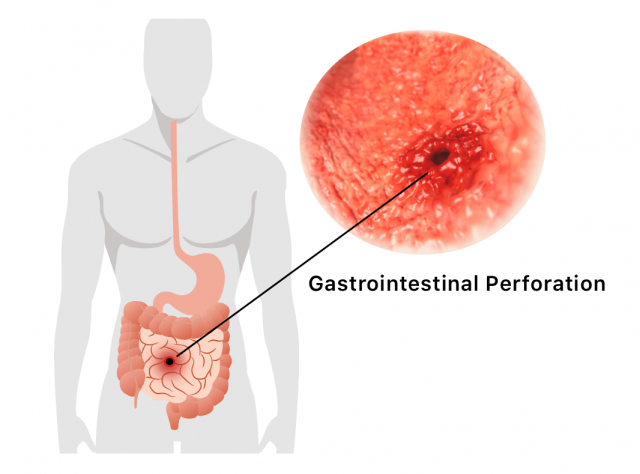 Gastrointestinal Perforation Illustration