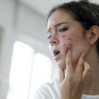 Young woman torching acne on her face