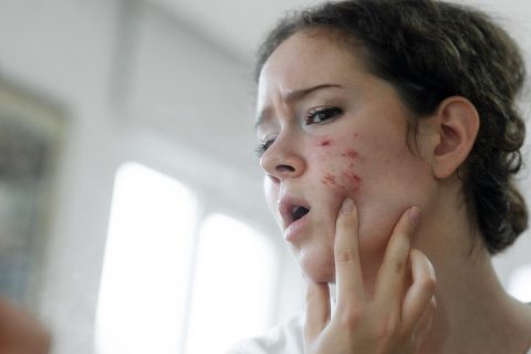 Young woman torching acne on her face