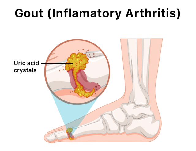 Illustration of gout in big toe