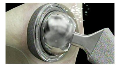 metal on metal hip implant friction