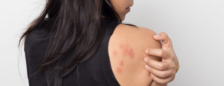 Woman with hives on her back shoulder