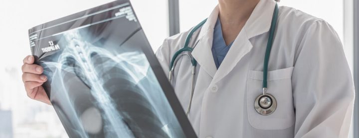 Doctor looking at x-ray of lungs