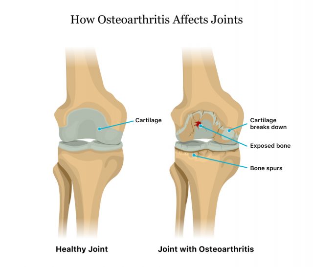 How Osteoarthritis Affects Joints