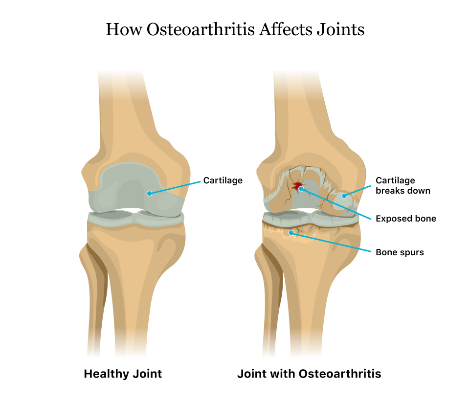 Mr arthritis osteoarthrosis 2 fok
