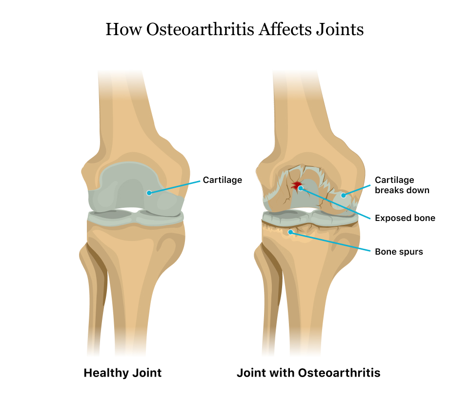 Osteoarthritis symptoms knee -