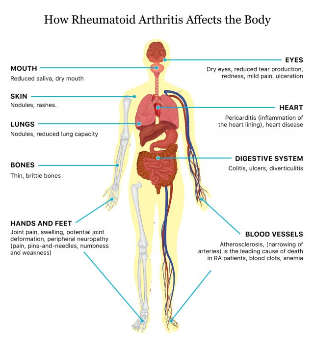 rheumatoid arthritis early stages)