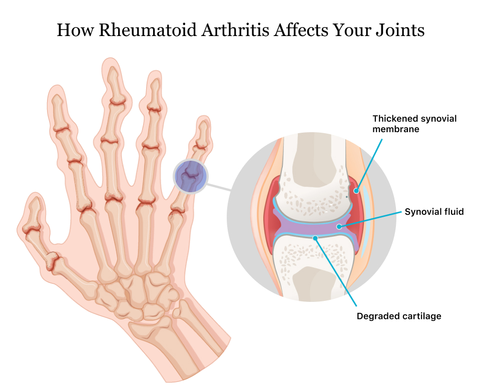 Assistive Devices for Rheumatoid Arthritis