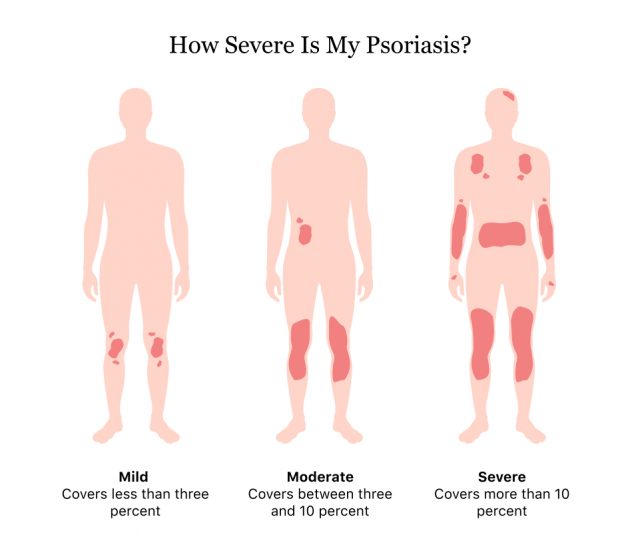 How Severe Is My Psoriasis?