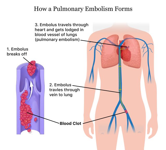 Pulmonary Embolism (PE)  Causes of a Blood Clot in the Lung