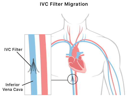 Illustration of IVC filter perforation